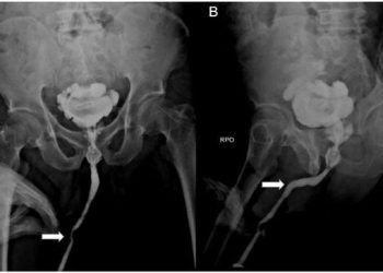 Kemasukan Kabel Di Kelamin,Pria Ini Alami ISK Dan Gagal Ginjal
